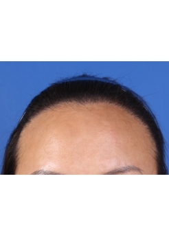 After Hair Transplant&nbsp;Hairline